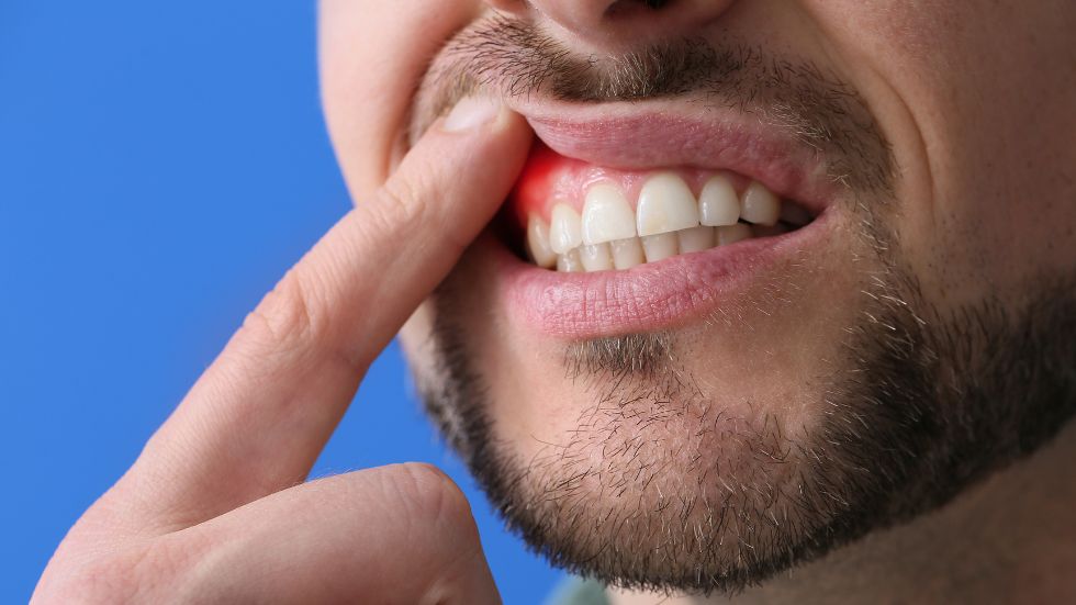 Prevención y tratamiento de la gingivitis en Albacete